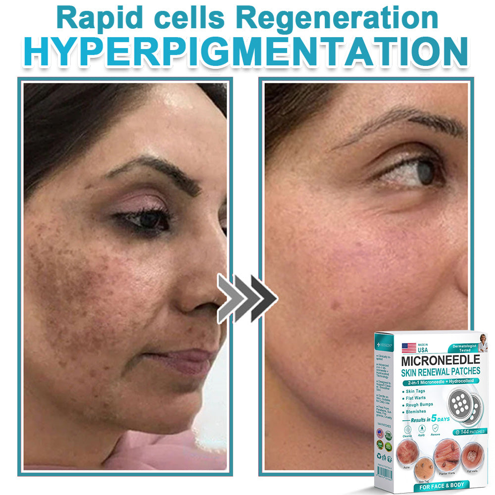 Hiskin ® 2-in-1 Microneedle & Hydrocolloid Patch👨‍⚕️ | Removes raised moles, acne, flat warts, and skin tags | Helps improve wrinkles, scars, and blemishes | Invisible patches for face and body💖