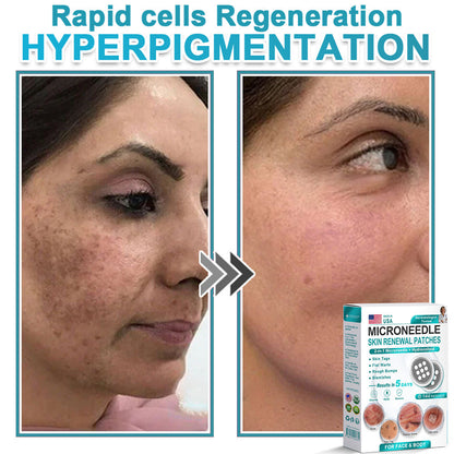Hiskin ® 2-in-1 Microneedle & Hydrocolloid Patch👨‍⚕️ | Removes raised moles, acne, flat warts, and skin tags | Helps improve wrinkles, scars, and blemishes | Invisible patches for face and body💖