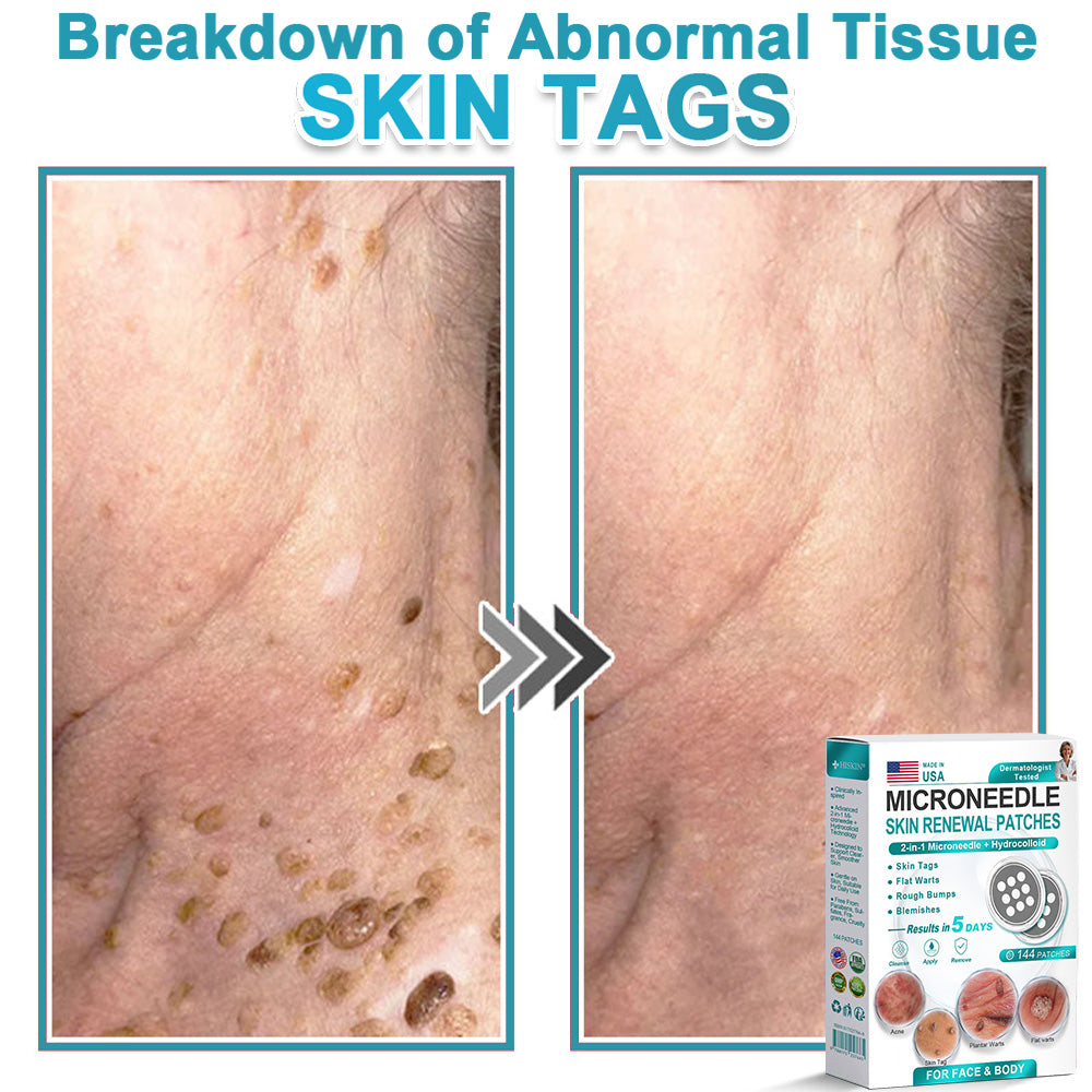 Hiskin ® 2-in-1 Microneedle & Hydrocolloid Patch👨‍⚕️ | Removes raised moles, acne, flat warts, and skin tags | Helps improve wrinkles, scars, and blemishes | Invisible patches for face and body💖