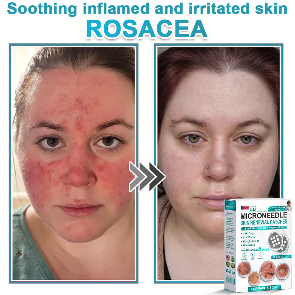 Hiskin ® 2-in-1 Microneedle & Hydrocolloid Patch👨‍⚕️ | Removes raised moles, acne, flat warts, and skin tags | Helps improve wrinkles, scars, and blemishes | Invisible patches for face and body💖