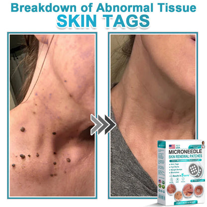 Hiskin ® 2-in-1 Microneedle & Hydrocolloid Patch👨‍⚕️ | Removes raised moles, acne, flat warts, and skin tags | Helps improve wrinkles, scars, and blemishes | Invisible patches for face and body💖