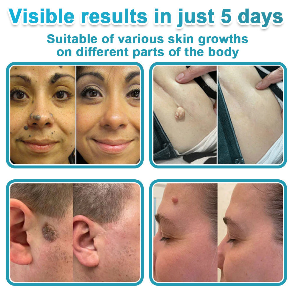 Hiskin ® 2-in-1 Microneedle & Hydrocolloid Patch👨‍⚕️ | Removes raised moles, acne, flat warts, and skin tags | Helps improve wrinkles, scars, and blemishes | Invisible patches for face and body💖