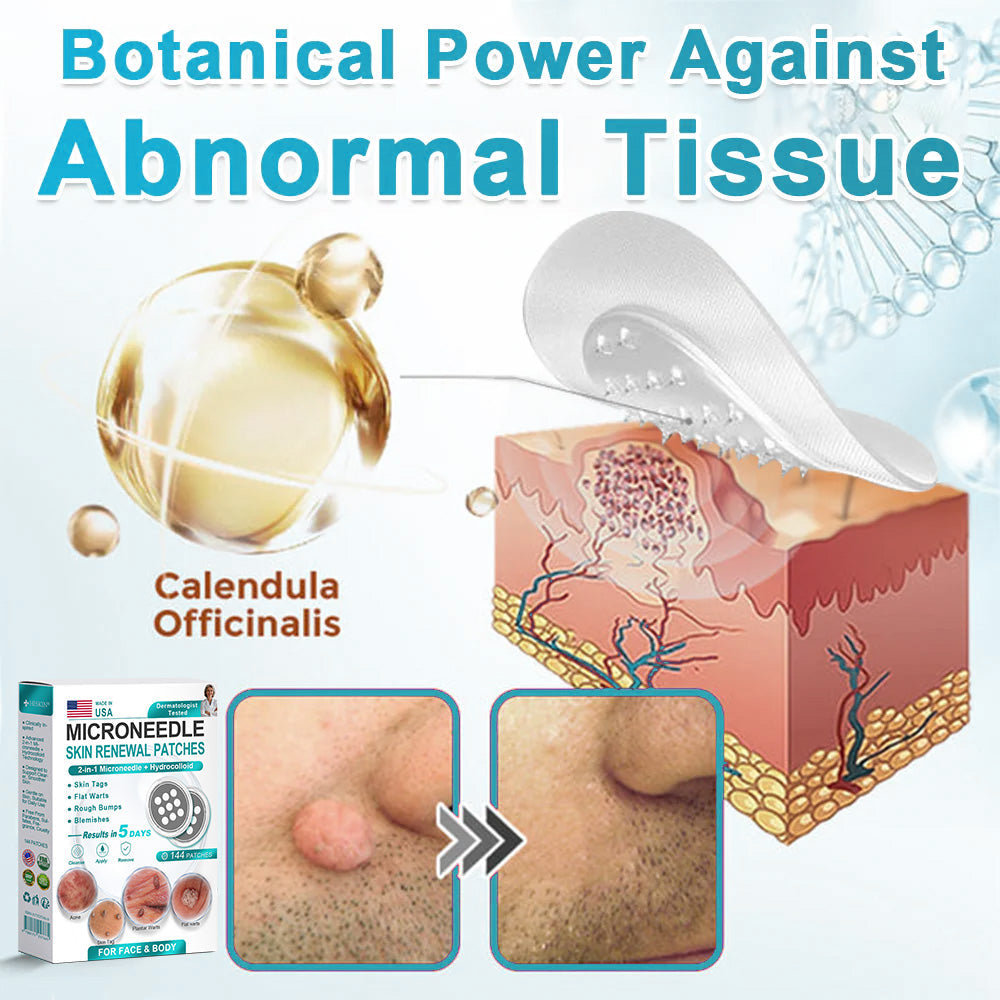 Hiskin ® 2-in-1 Microneedle & Hydrocolloid Patch👨‍⚕️ | Removes raised moles, acne, flat warts, and skin tags | Helps improve wrinkles, scars, and blemishes | Invisible patches for face and body💖