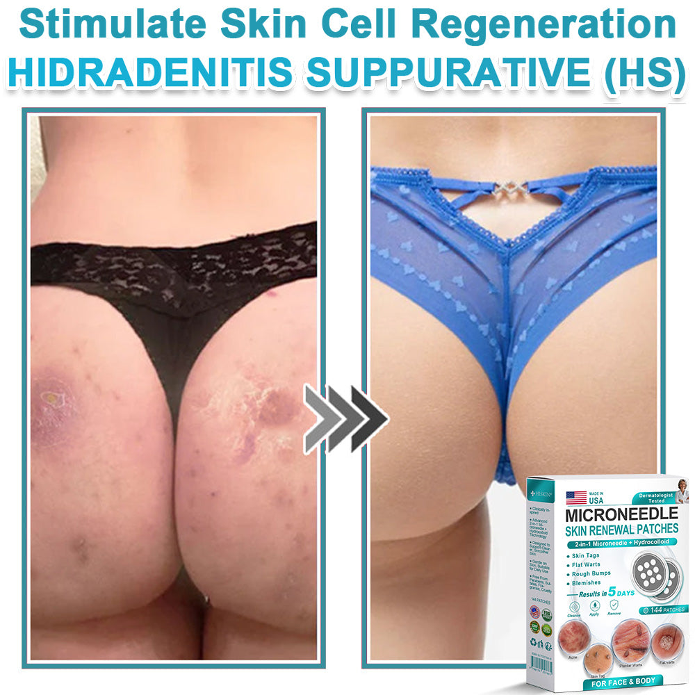 Hiskin ® 2-in-1 Microneedle & Hydrocolloid Patch👨‍⚕️ | Removes raised moles, acne, flat warts, and skin tags | Helps improve wrinkles, scars, and blemishes | Invisible patches for face and body💖