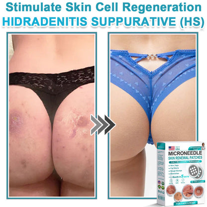 Hiskin ® 2-in-1 Microneedle & Hydrocolloid Patch👨‍⚕️ | Removes raised moles, acne, flat warts, and skin tags | Helps improve wrinkles, scars, and blemishes | Invisible patches for face and body💖