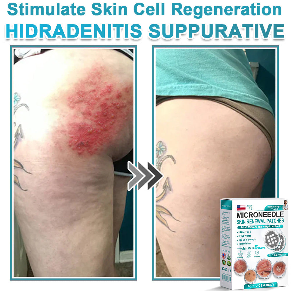 Hiskin ® 2-in-1 Microneedle & Hydrocolloid Patch👨‍⚕️ | Removes raised moles, acne, flat warts, and skin tags | Helps improve wrinkles, scars, and blemishes | Invisible patches for face and body💖