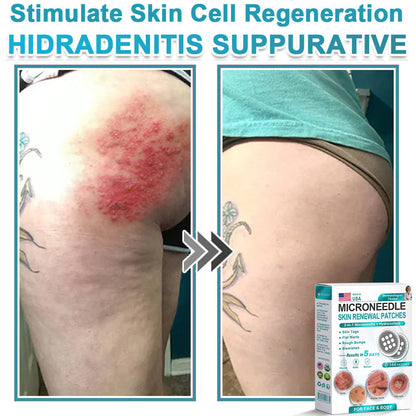 Hiskin ® 2-in-1 Microneedle & Hydrocolloid Patch👨‍⚕️ | Removes raised moles, acne, flat warts, and skin tags | Helps improve wrinkles, scars, and blemishes | Invisible patches for face and body💖