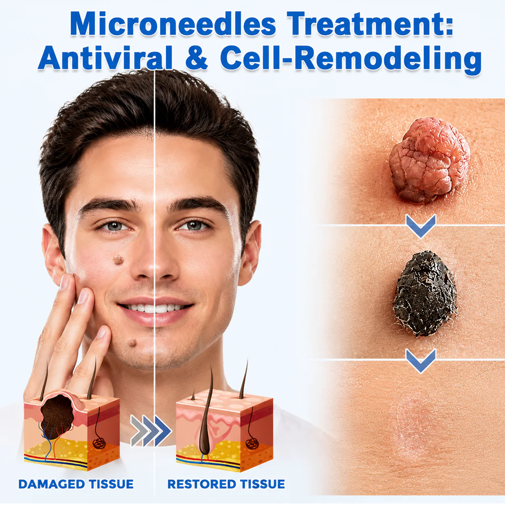 Hiskin ® 2-in-1 Microneedle & Hydrocolloid Patch👨‍⚕️ | Removes raised moles, acne, flat warts, and skin tags | Helps improve wrinkles, scars, and blemishes | Invisible patches for face and body💖