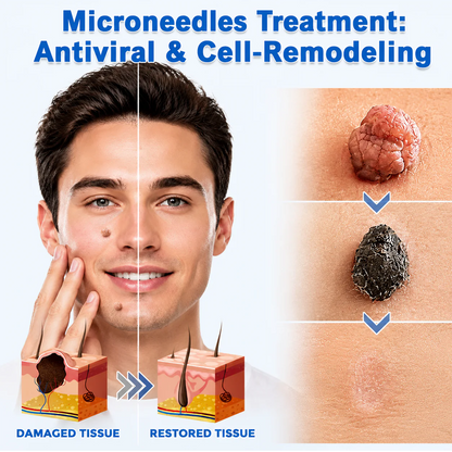 Hiskin ® 2-in-1 Microneedle & Hydrocolloid Patch👨‍⚕️ | Removes raised moles, acne, flat warts, and skin tags | Helps improve wrinkles, scars, and blemishes | Invisible patches for face and body💖