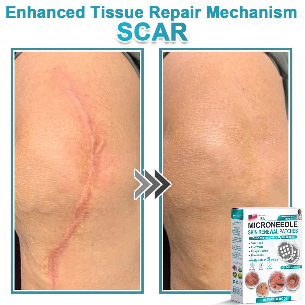 Hiskin ® 2-in-1 Microneedle & Hydrocolloid Patch👨‍⚕️ | Removes raised moles, acne, flat warts, and skin tags | Helps improve wrinkles, scars, and blemishes | Invisible patches for face and body💖