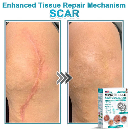Hiskin ® 2-in-1 Microneedle & Hydrocolloid Patch👨‍⚕️ | Removes raised moles, acne, flat warts, and skin tags | Helps improve wrinkles, scars, and blemishes | Invisible patches for face and body💖